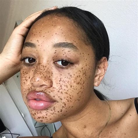 What Causes New Freckles